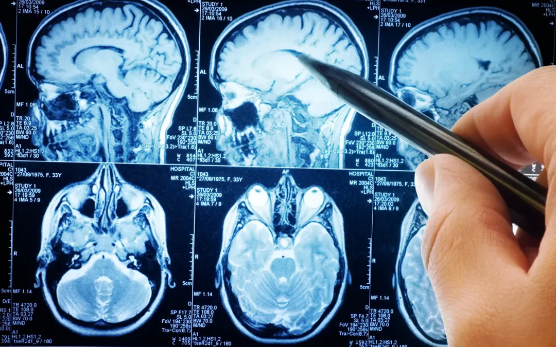 Tumori cerebrali, dalle CAR-T nuove speranze di cura per i gliomi inoperabili